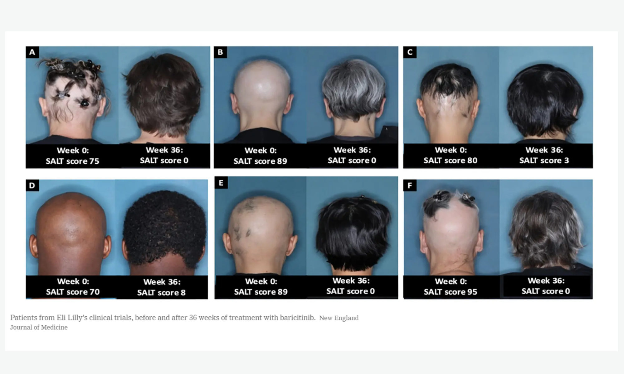 . Approves Alopecia Drug That Restores Hair Growth in Many Patients –  Beckman Laser Institute
